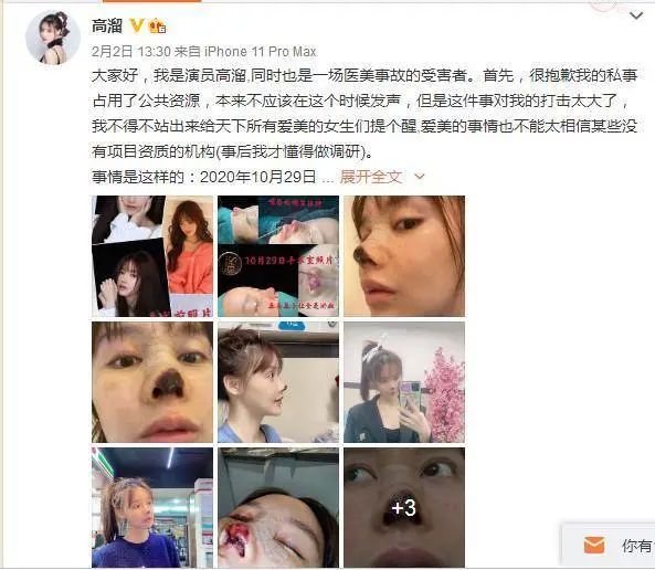 整容失败的女明星中国_医美事故受害者高溜_演员高溜整容失败鼻头坏死维权